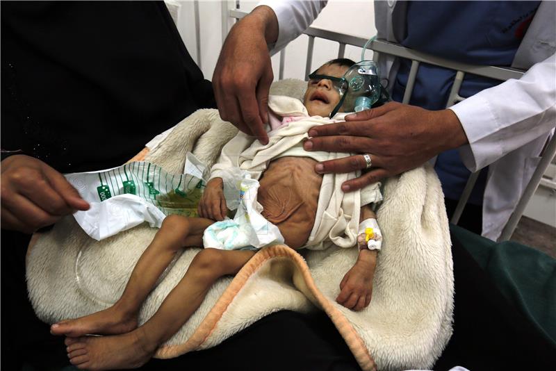 Više od 8000 djece do pet godina liječeno od akutne pothranjenosti u Gazi